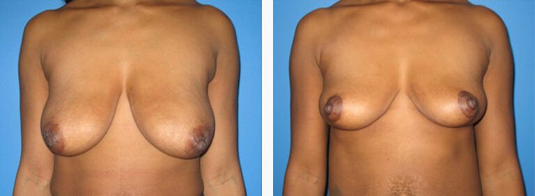 Breast-Lift-Case-2-1