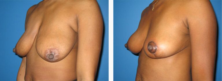 Breast-Lift-Case-2-2