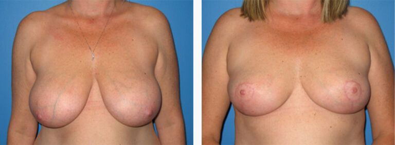 Breast-Lift-Case-3-1