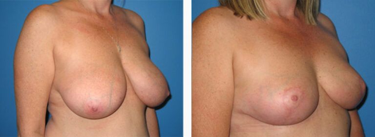 Breast-Lift-Case-3-2
