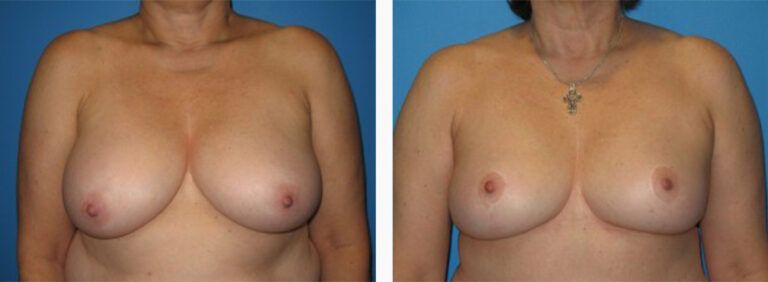 Breast-Lift-Case-4-1