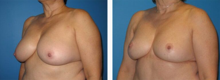 Breast-Lift-Case-4-2