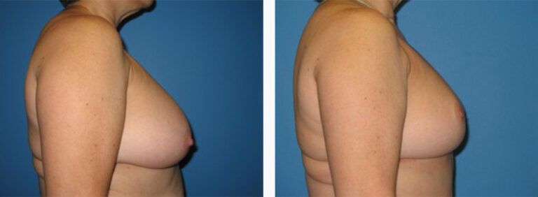 Breast-Lift-Case-4-3