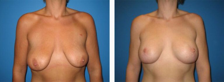 Breast-Lift-Case-5-1