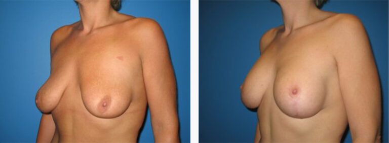 Breast-Lift-Case-5-2
