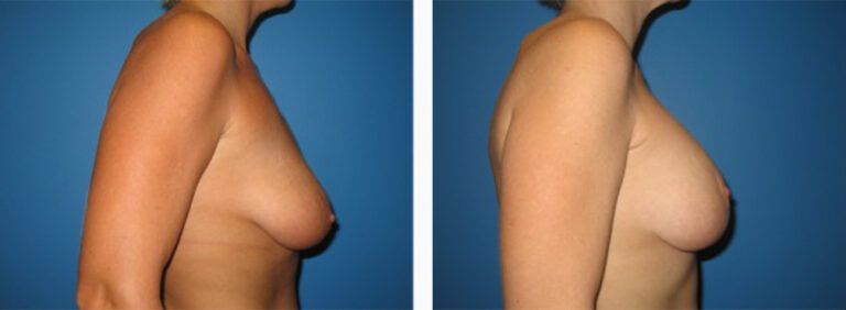 Breast-Lift-Case-5-3