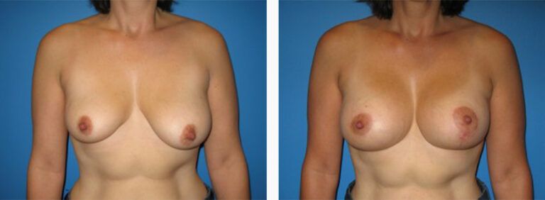 Breast-Lift-Case-6-1