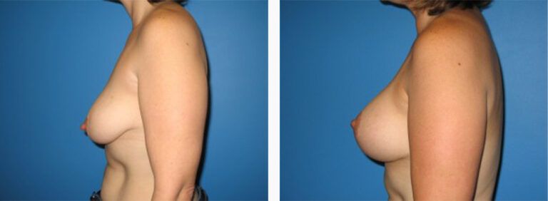 Breast-Lift-Case-6-2