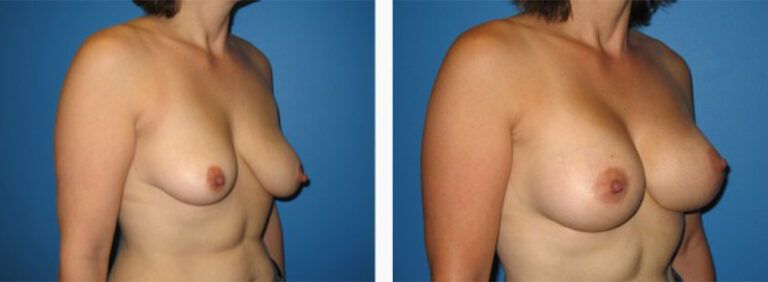 Breast-Lift-Case-6-3