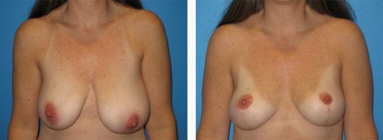 Breast-Lift-Case-7-1