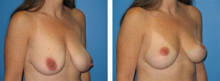Breast-Lift-Case-7-2