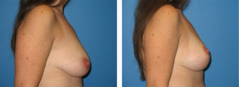 Breast-Lift-Case-7-3