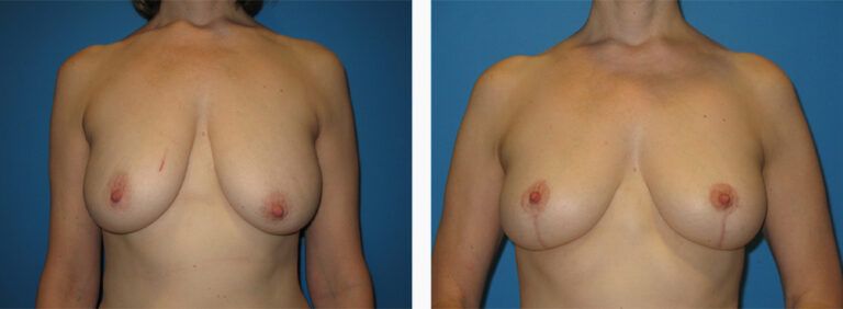 Breast-Lift-Case-8-1