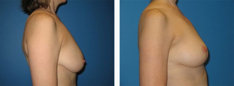 Breast-Lift-Case-8-2