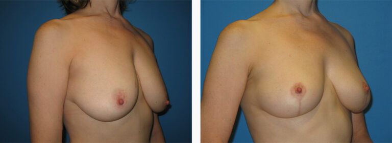 Breast-Lift-Case-8-3