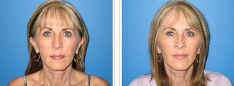 Facelift-with-Platysmaplasty-Case-1-1