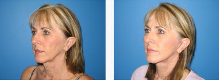 Facelift-with-Platysmaplasty-Case-1-2