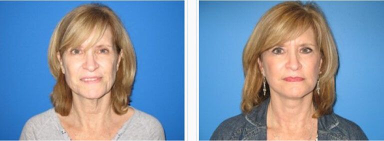 Facelift-with-Platysmaplasty-Case-2-1