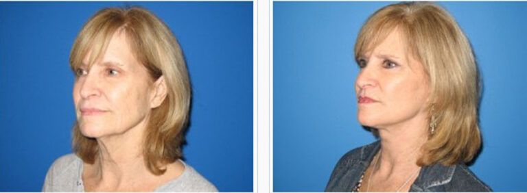 Facelift-with-Platysmaplasty-Case-2-2