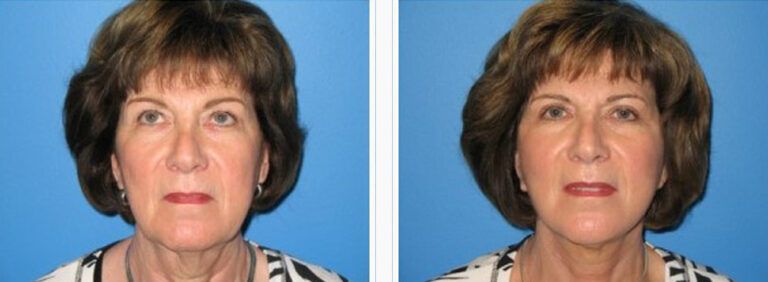 Facelift-with-Platysmaplasty-Case-3-1