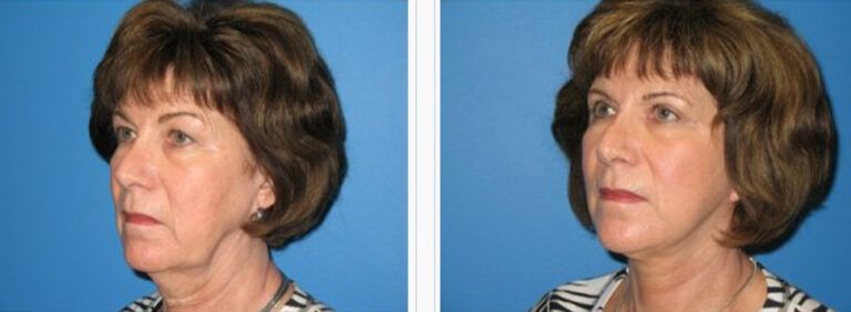 Facelift-with-Platysmaplasty-Case-3--2