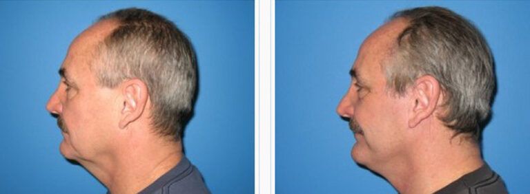 Facelift-with-Platysmaplasty-Case-4-1