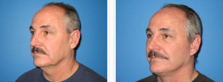 Facelift-with-Platysmaplasty-Case-4-2