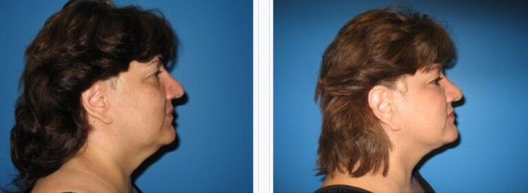 Facelift-with-Platysmaplasty-Case-5-1