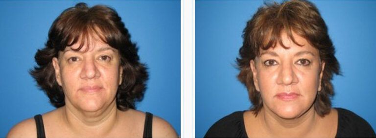 Facelift-with-Platysmaplasty-Case-5-2