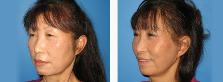 Facelift-with-Platysmaplasty-Case-6-1
