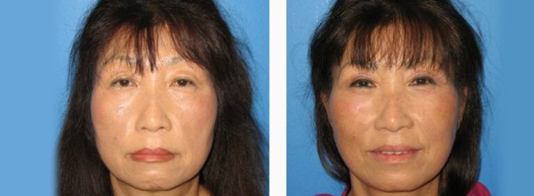 Facelift-with-Platysmaplasty-Case-6-2