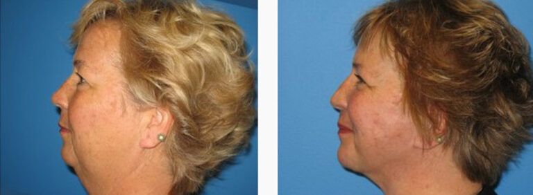 Facelift-with-Platysmaplasty-Case-7-1