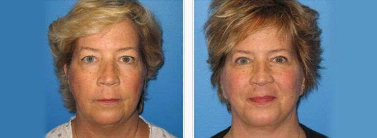 Facelift-with-Platysmaplasty-Case-7-2
