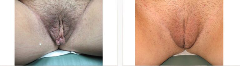 Labiaplasty-Case-1-2