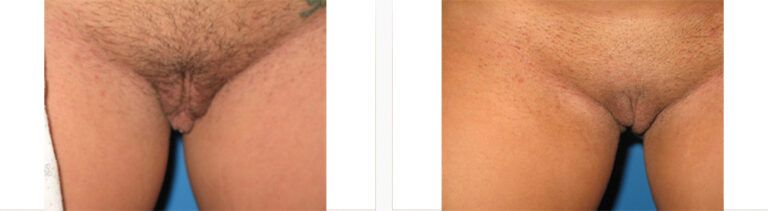 Labiaplasty-Case-1