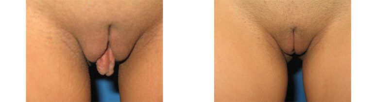 Labiaplasty-Case-2