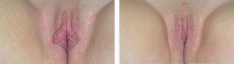Labiaplasty-Case-3_final