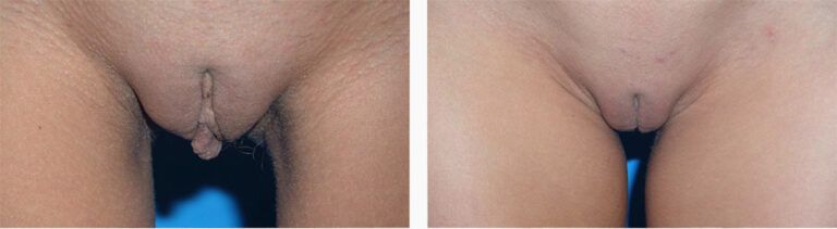Labiaplasty-Case-4-1