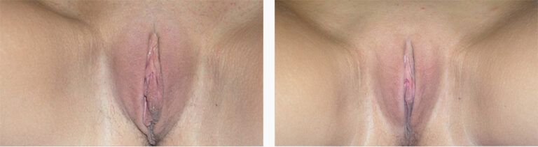 Labiaplasty-Case-4-2