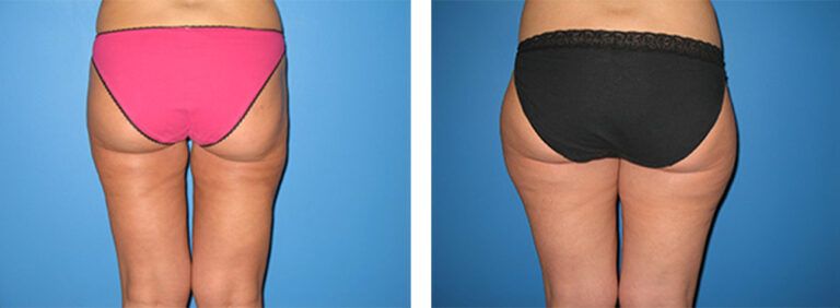Liposuction-Case-1