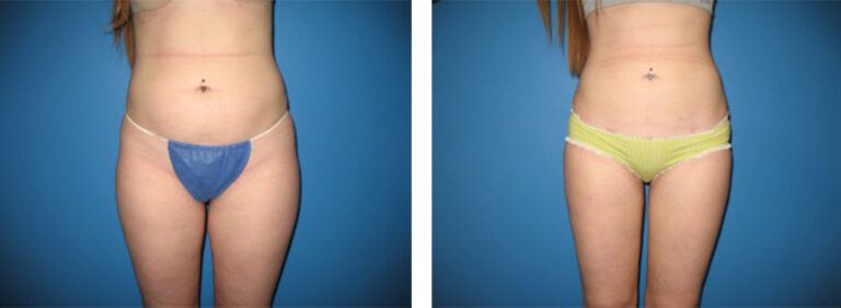 Liposuction-Case-10-1