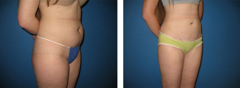 Liposuction-Case-10-2