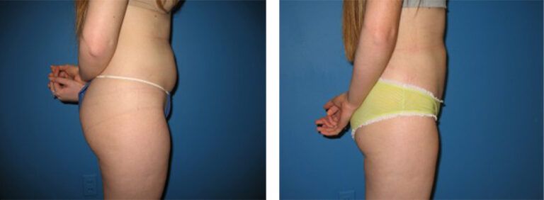Liposuction-Case-10-3