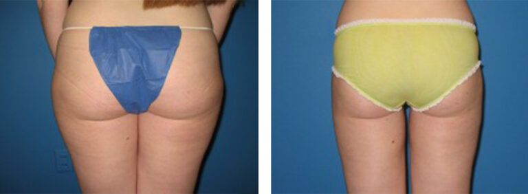 Liposuction-Case-10-4