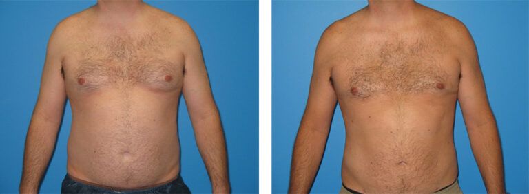Liposuction-Case-12-1
