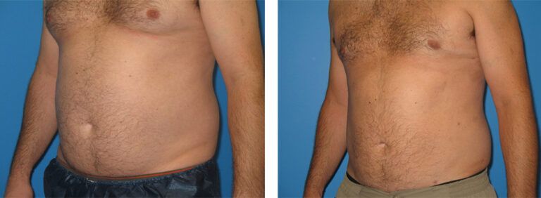 Liposuction-Case-12-2
