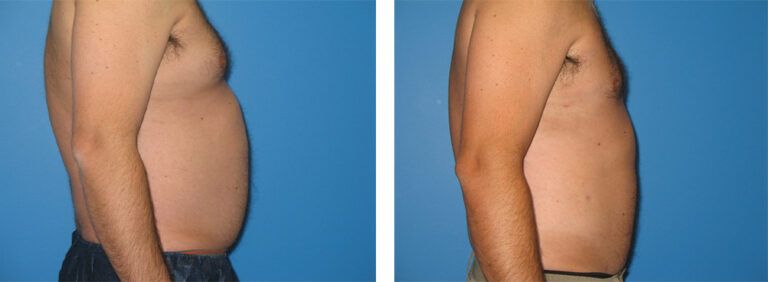 Liposuction-Case-12-3