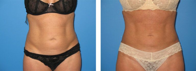 Liposuction-Case-13-1