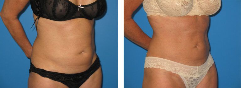 Liposuction-Case-13-2