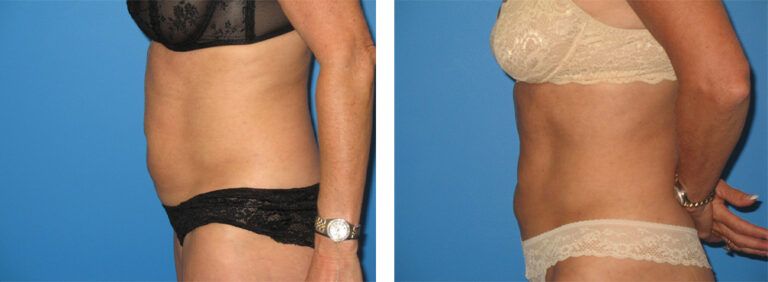 Liposuction-Case-13-3